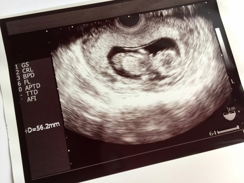 胎児の画像